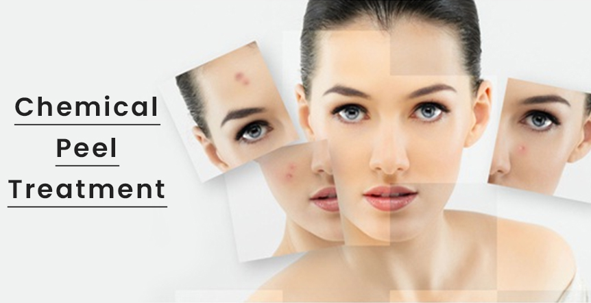 Chemical Peel Treatment